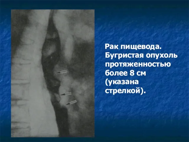 Рак пищевода. Бугристая опухоль протяженностью более 8 см (указана стрелкой).