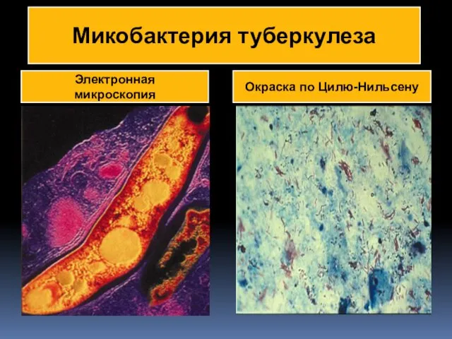 Микобактерия туберкулеза Электронная микроскопия Окраска по Цилю-Нильсену