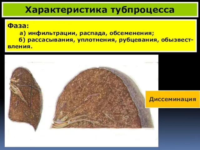 Фаза: а) инфильтрации, распада, обсеменения; б) рассасывания, уплотнения, рубцевания, обызвест- вления. Характеристика тубпроцесса Диссеминация