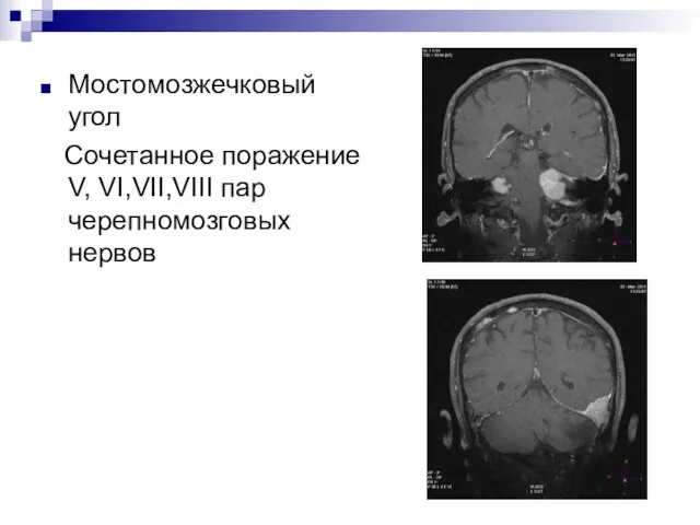 Мостомозжечковый угол Сочетанное поражение V, VI,VII,VIII пар черепномозговых нервов