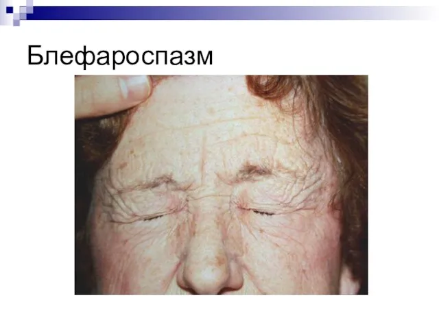 Блефароспазм