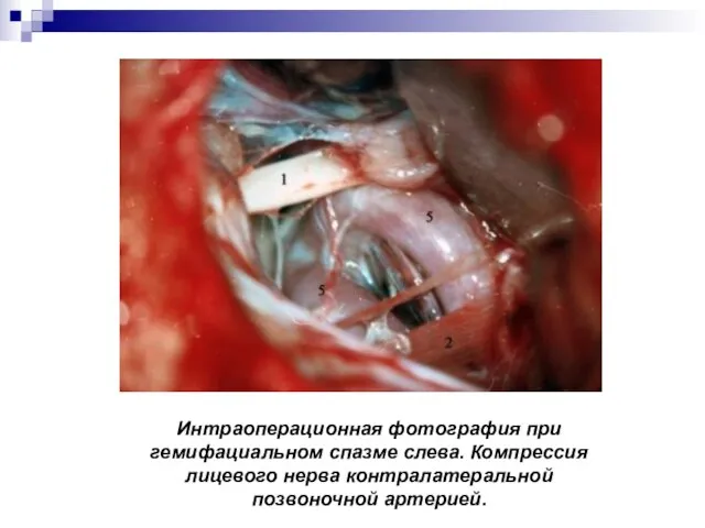 Интраоперационная фотография при гемифациальном спазме слева. Компрессия лицевого нерва контралатеральной позвоночной артерией.