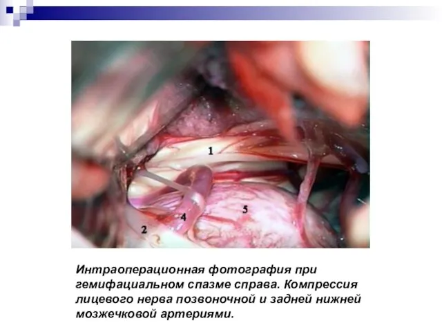 Интраоперационная фотография при гемифациальном спазме справа. Компрессия лицевого нерва позвоночной и задней нижней мозжечковой артериями.