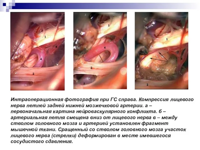 Интраоперационная фотография при ГС справа. Компрессия лицевого нерва петлей задней нижней