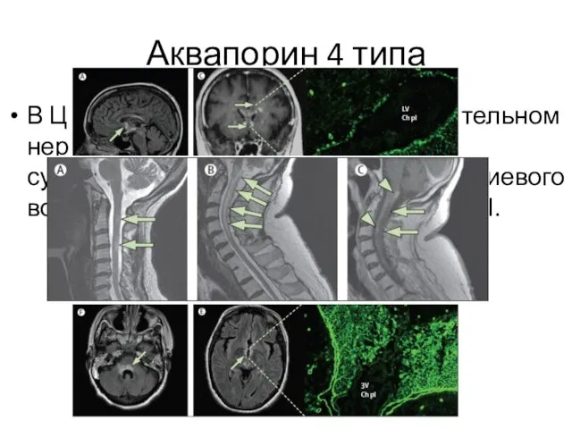 Аквапорин 4 типа В ЦНС AQP4 сконцентрированы в зрительном нерве, гипоталамусе,