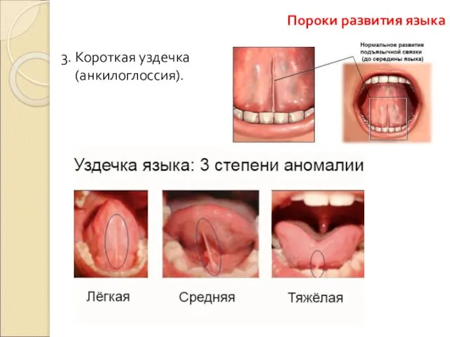 3. Короткая уздечка (анкилоглоссия). Пороки развития языка