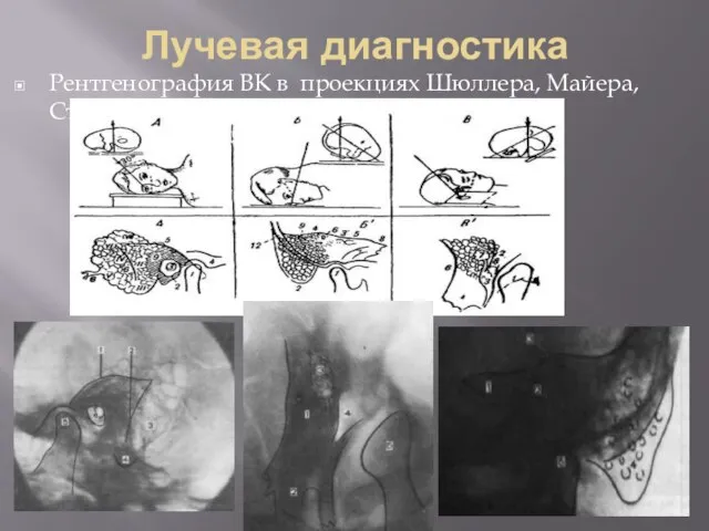 Лучевая диагностика Рентгенография ВК в проекциях Шюллера, Майера, Стенверса