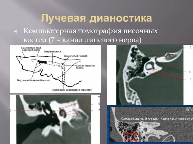 Лучевая дианостика Компьютерная томография височных костей (7 – канал лицевого нерва)