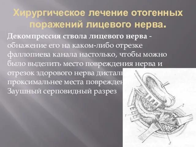 Хирургическое лечение отогенных поражений лицевого нерва. Декомпрессия ствола лицевого нерва -