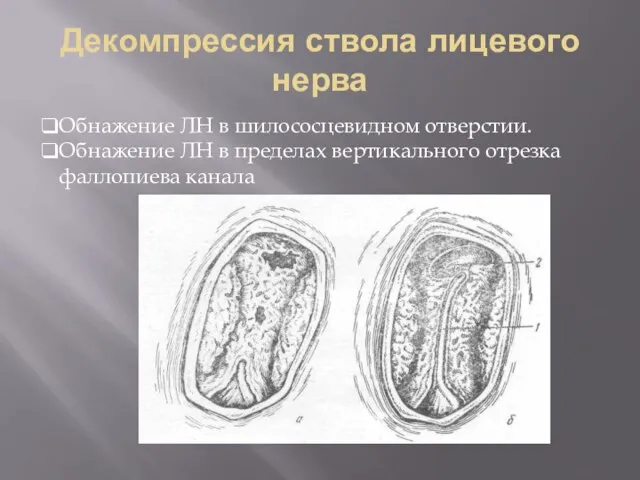 Декомпрессия ствола лицевого нерва Обнажение ЛН в шилососцевидном отверстии. Обнажение ЛН