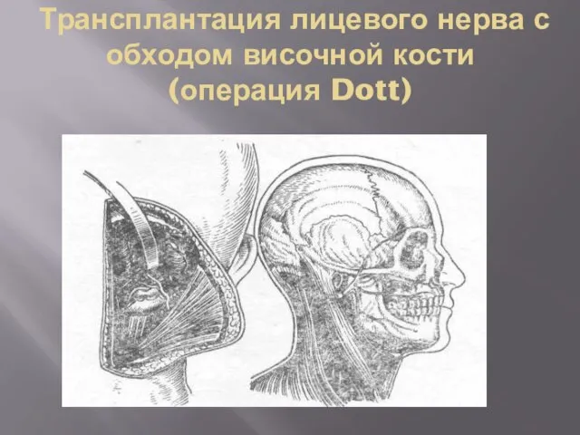 Трансплантация лицевого нерва с обходом височной кости (операция Dott)