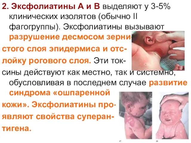 2. Эксфолиатины А и В выделяют у 3-5% клинических изолятов (обычно