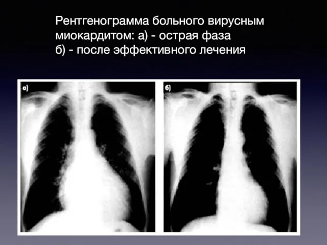 Рентгенограмма больного вирусным миокардитом: а) - острая фаза б) - после эффективного лечения