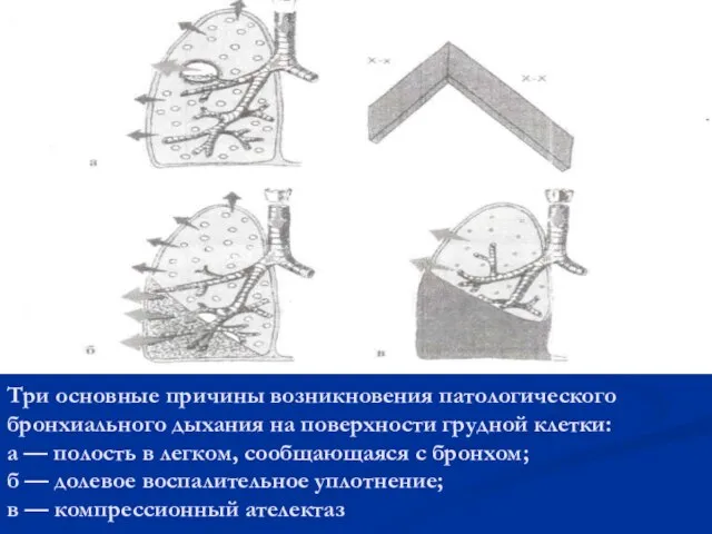 Три основные причины возникновения патологического бронхиального дыхания на поверхности грудной клетки: