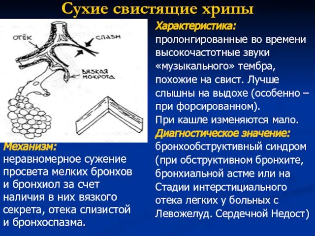 Сухие свистящие хрипы Механизм: неравномерное сужение просвета мелких бронхов и бронхиол