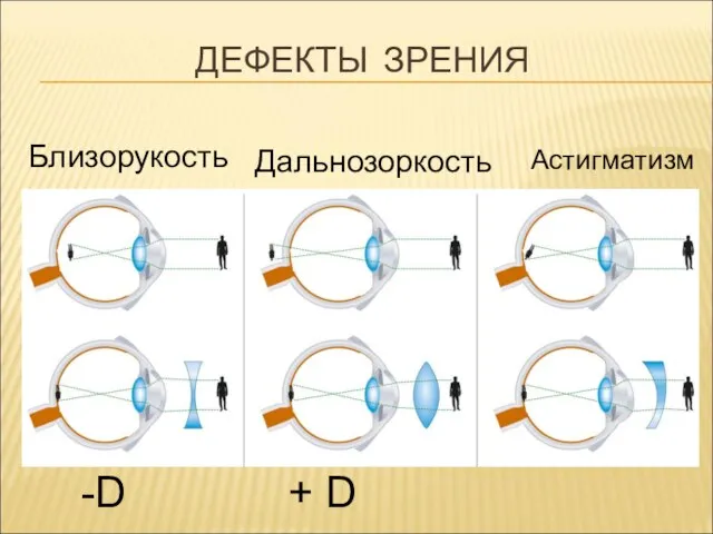 ДЕФЕКТЫ ЗРЕНИЯ Близорукость Дальнозоркость Астигматизм -D + D