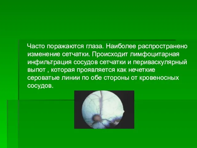 Часто поражаются глаза. Наиболее распространено изменение сетчатки. Происходит лимфоцитарная инфильтрация сосудов