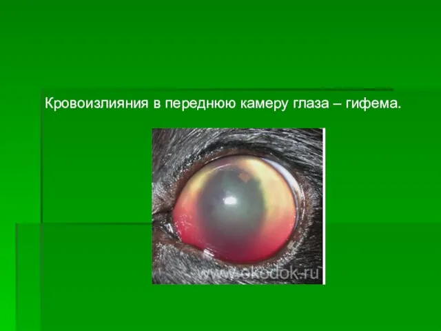 Кровоизлияния в переднюю камеру глаза – гифема.