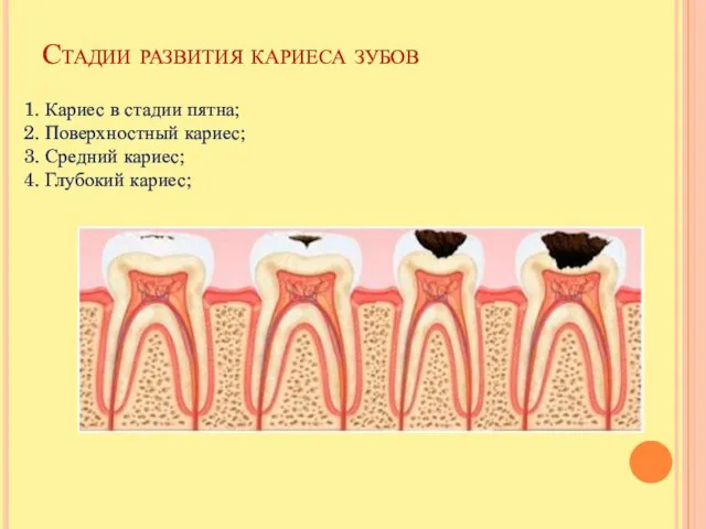 Стадии развития кариеса зубов 1. Кариес в стадии пятна; 2. Поверхностный