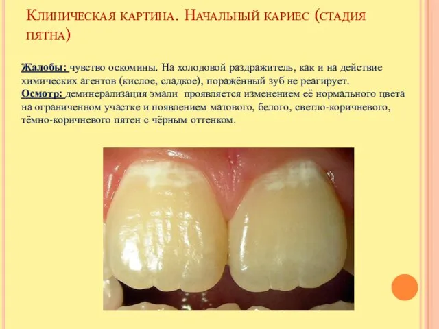 Клиническая картина. Начальный кариес (стадия пятна) Жалобы: чувство оскомины. На холодовой