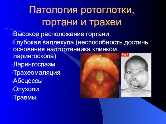 Патология ротоглотки, гортани и трахеи Высокое расположение гортани Глубокая валлекула (неспособность