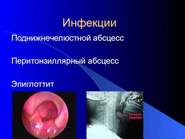 Инфекции Поднижнечелюстной абсцесс Перитонзиллярный абсцесс Эпиглоттит