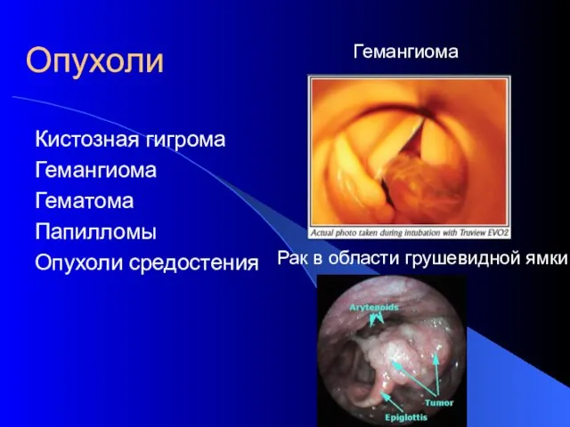 Опухоли Кистозная гигрома Гемангиома Гематома Папилломы Опухоли средостения Рак в области грушевидной ямки Гемангиома