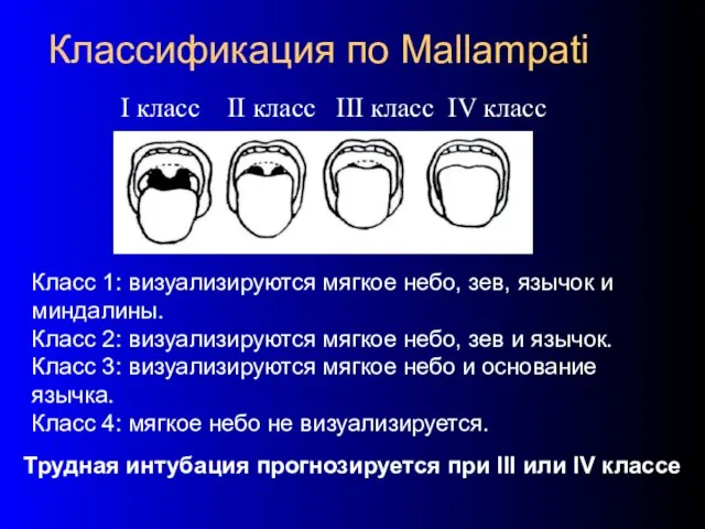 Классификация по Mallampati Трудная интубация прогнозируется при III или IV классе