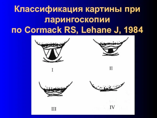 Классификация картины при ларингоскопии по Cormack RS, Lehane J, 1984