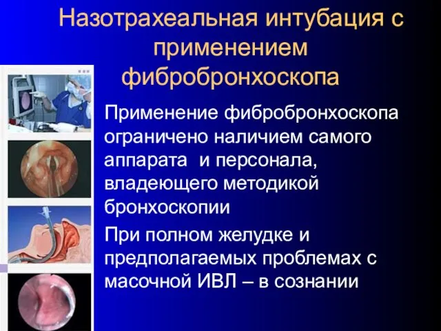 Назотрахеальная интубация с применением фибробронхоскопа Применение фибробронхоскопа ограничено наличием самого аппарата