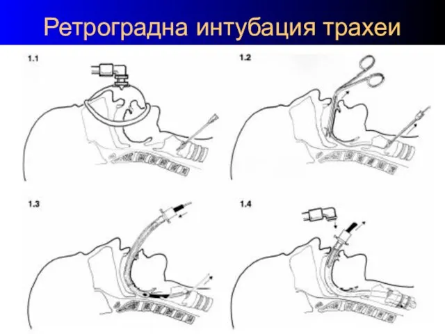 Ретроградна интубация трахеи