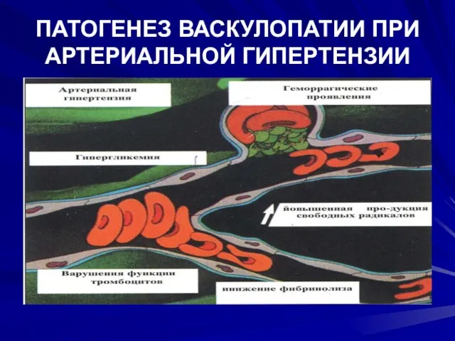 ПАТОГЕНЕЗ ВАСКУЛОПАТИИ ПРИ АРТЕРИАЛЬНОЙ ГИПЕРТЕНЗИИ