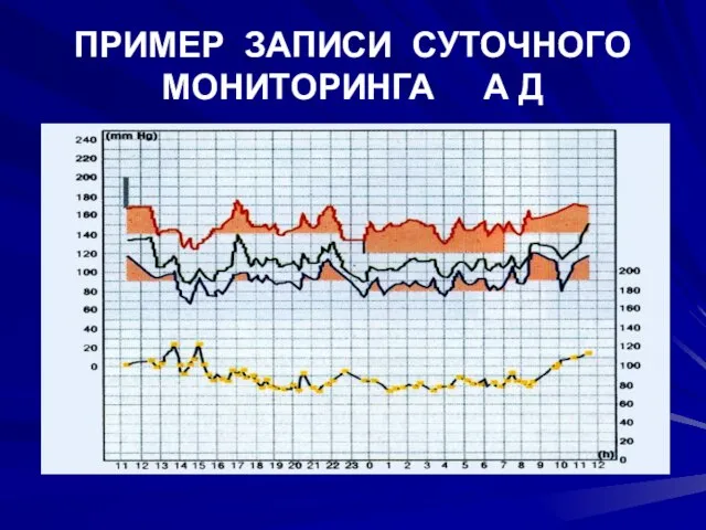 ПРИМЕР ЗАПИСИ СУТОЧНОГО МОНИТОРИНГА А Д