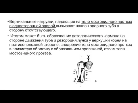 Вертикальные нагрузки, падающие на тело мостовидного протеза с односторонней опорой вызывают