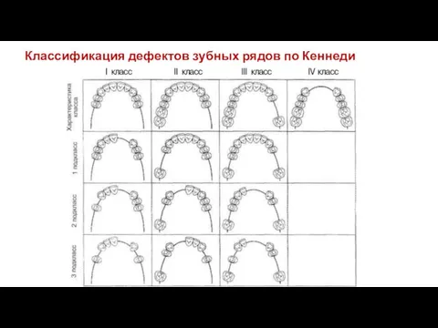 Классификация дефектов зубных рядов по Кеннеди