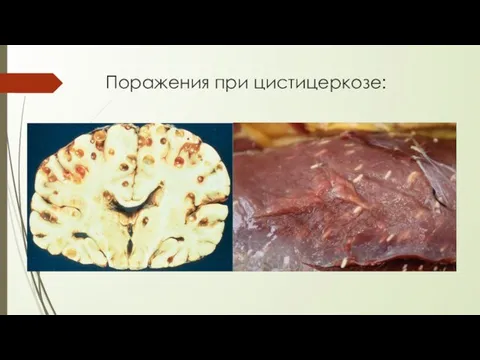 Поражения при цистицеркозе: