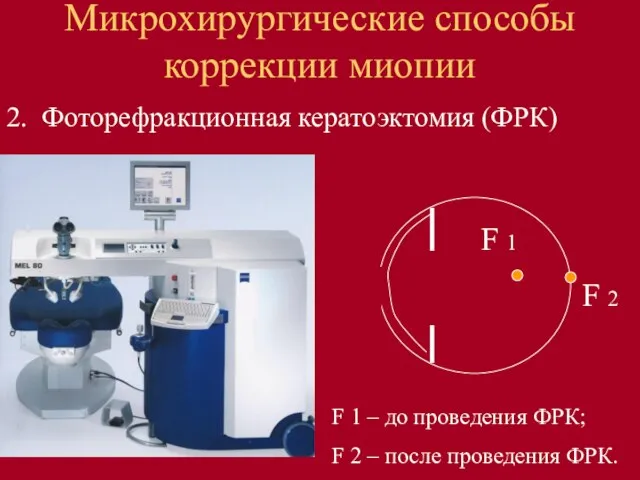 2. Фоторефракционная кератоэктомия (ФРК) Микрохирургические способы коррекции миопии F 1 –