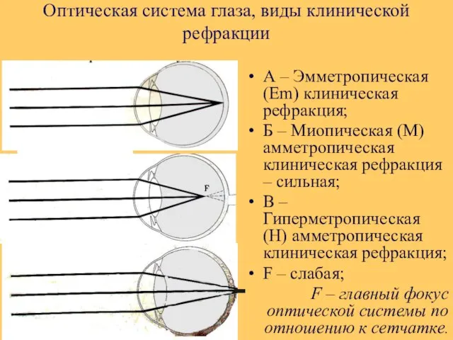 Оптическая система глаза, виды клинической рефракции А – Эмметропическая (Em) клиническая