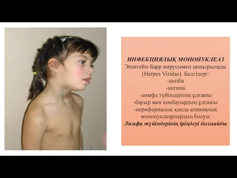 ИНФЕКЦИЯЛЫҚ МОНОНУКЛЕАЗ Эпштейн-Барр вирусымен шақырылады (Herpes Viridae). Белгілері: -қызба -ангина -лимфа