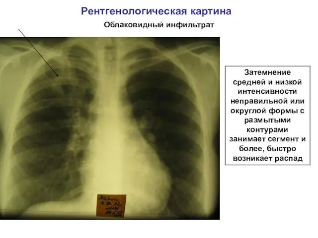 Рентгенологическая картина Облаковидный инфильтрат Затемнение средней и низкой интенсивности неправильной или