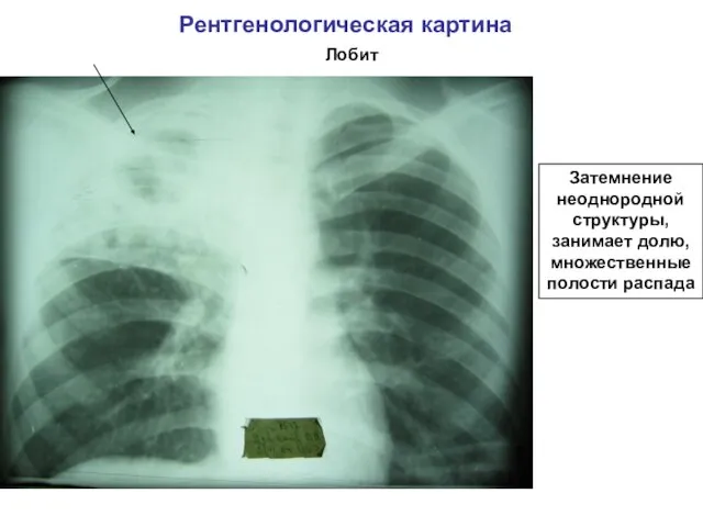 Рентгенологическая картина Лобит Затемнение неоднородной структуры, занимает долю, множественные полости распада