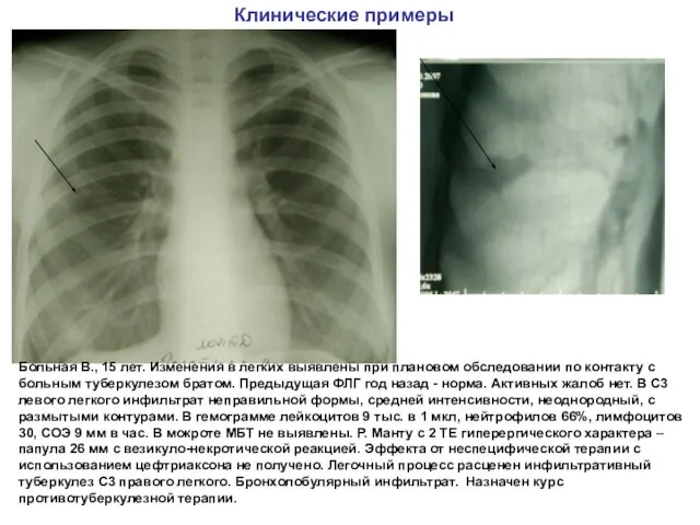 Клинические примеры Больная В., 15 лет. Изменения в легких выявлены при