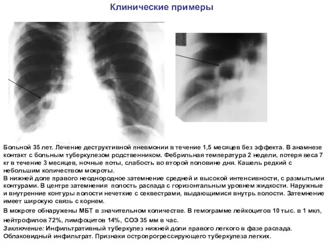 Больной 35 лет. Лечение деструктивной пневмонии в течение 1,5 месяцев без