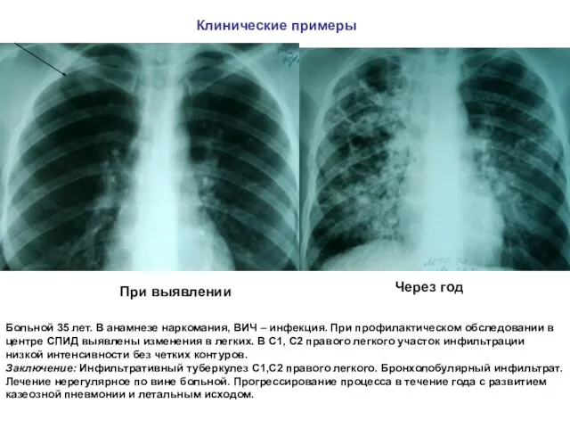 Больной 35 лет. В анамнезе наркомания, ВИЧ – инфекция. При профилактическом