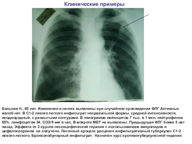 Клинические примеры Больная Н., 65 лет. Изменения в легких выявлены при