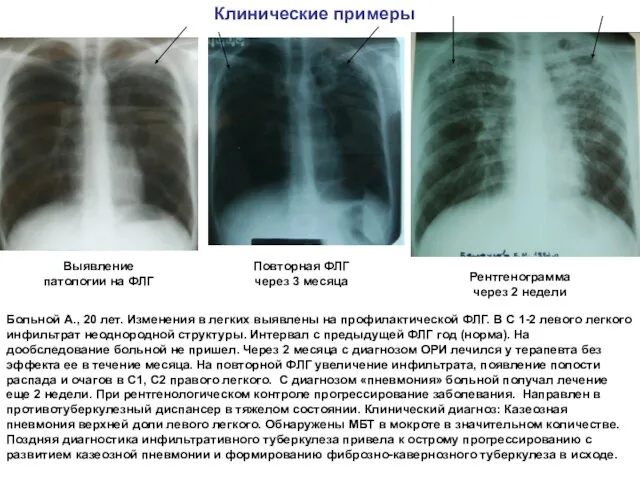 Клинические примеры Больной А., 20 лет. Изменения в легких выявлены на