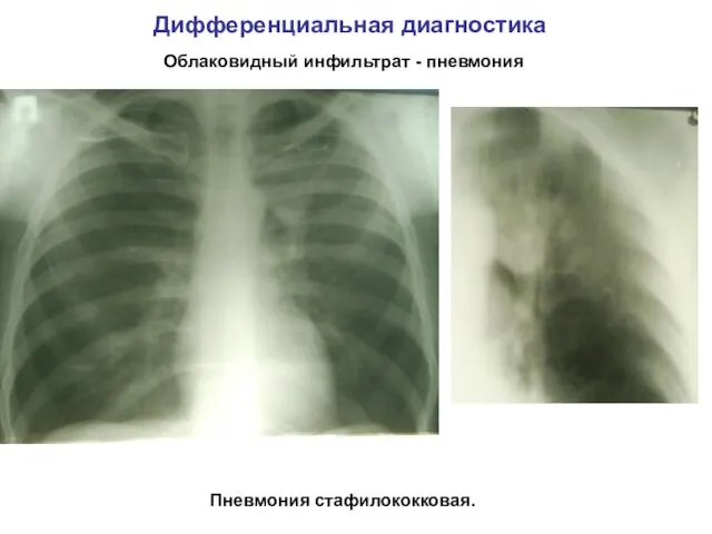 Дифференциальная диагностика Пневмония стафилококковая. Облаковидный инфильтрат - пневмония