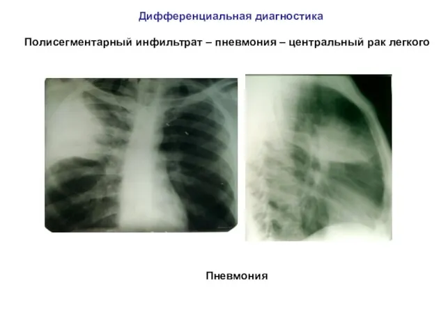 Дифференциальная диагностика Полисегментарный инфильтрат – пневмония – центральный рак легкого Пневмония