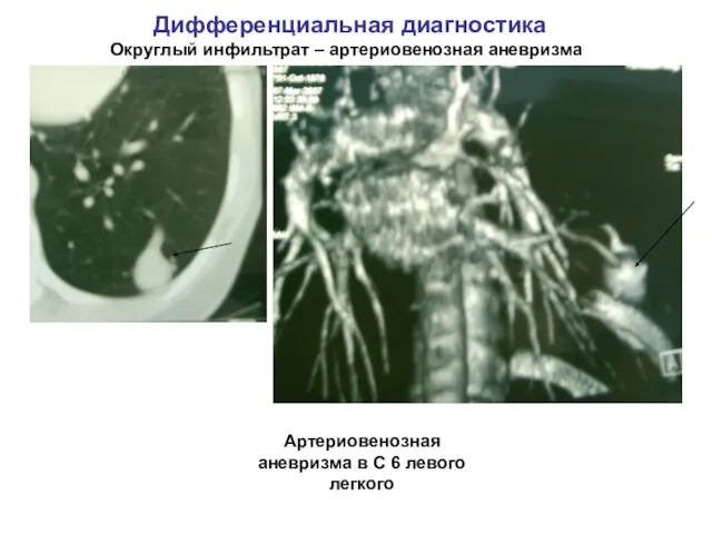 Дифференциальная диагностика Округлый инфильтрат – артериовенозная аневризма Артериовенозная аневризма в С 6 левого легкого