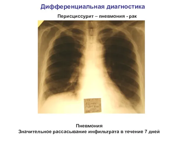 Дифференциальная диагностика Перисциссурит – пневмония - рак Пневмония Значительное рассасывание инфильтрата в течение 7 дней